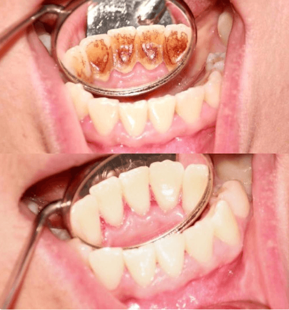Професійна чистка зубів